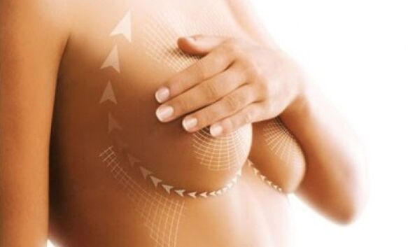 suture lifting for breast augmentation