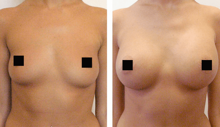 breasts before and after augmentation with hyaluronic acid