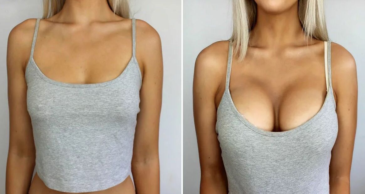 Breast widening 3 size