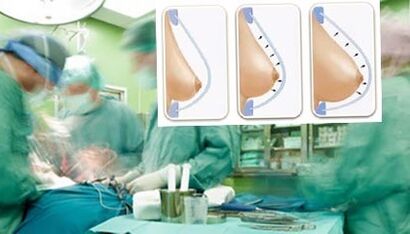 How the breast lipilifting is carried out