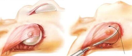 How the functioning of breast augmentation is carried out