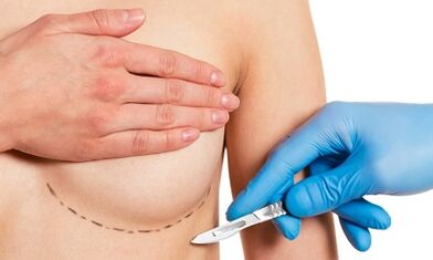 Sub-dynamic access to the widening of the breast with the implants