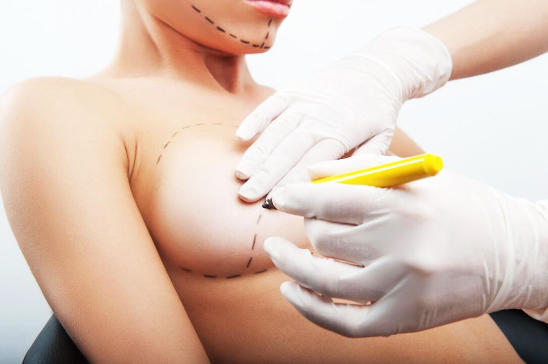 markings before breast augmentation surgery
