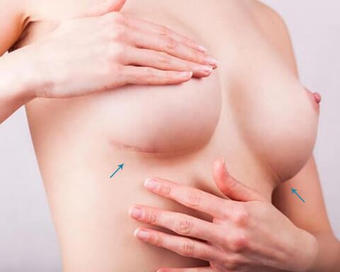 Breast widening with implants