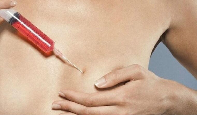Breast augmentation using hyaluronic acid injections
