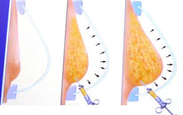 breast augmentation with fat